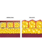 cellulite Peau d'orange